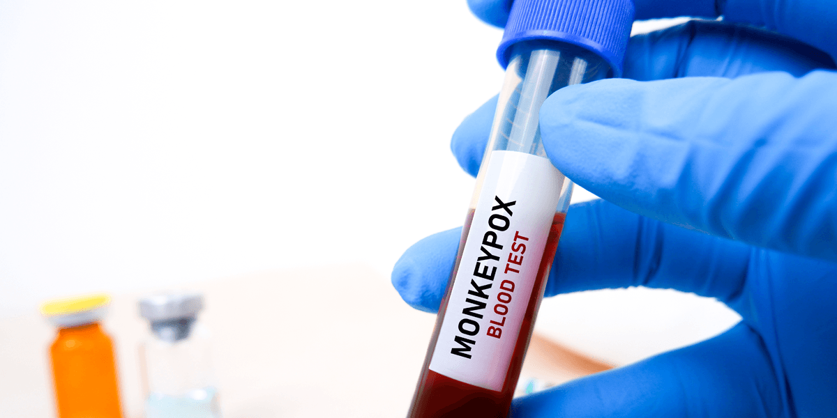 Monkeypox: teste para a doença é incorporado ao Rol da ANS